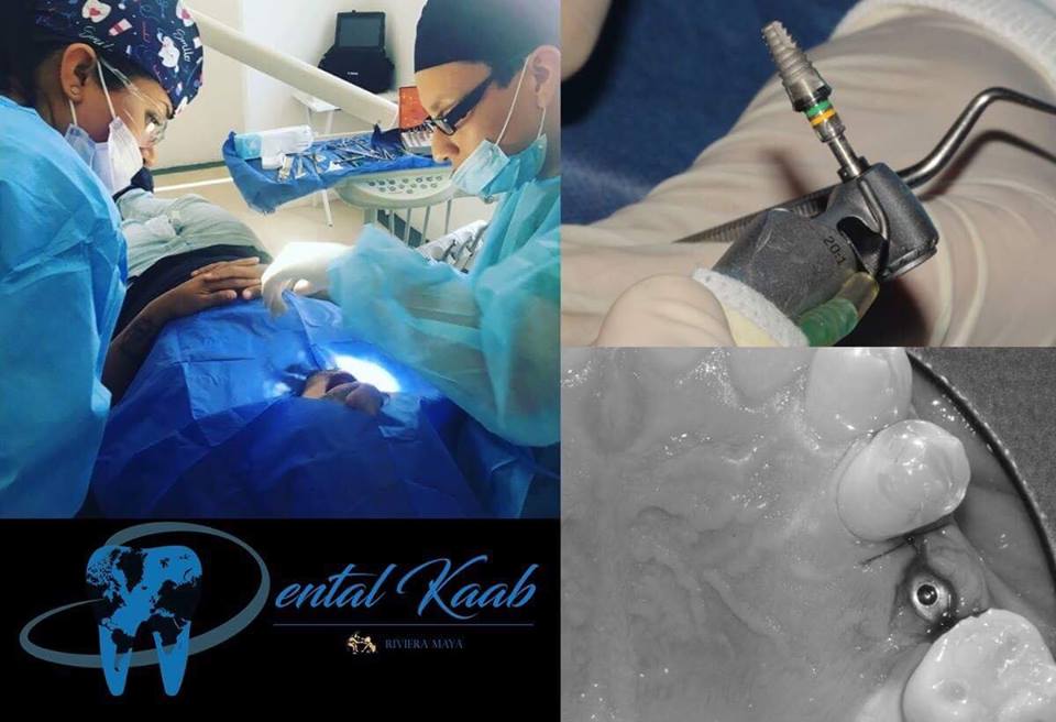 Dental kaab playa del carmen best wedding resorts playa del carmen